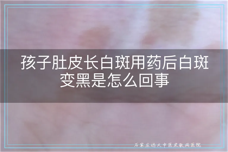 孩子肚皮长白斑用药后白斑变黑是怎么回事
