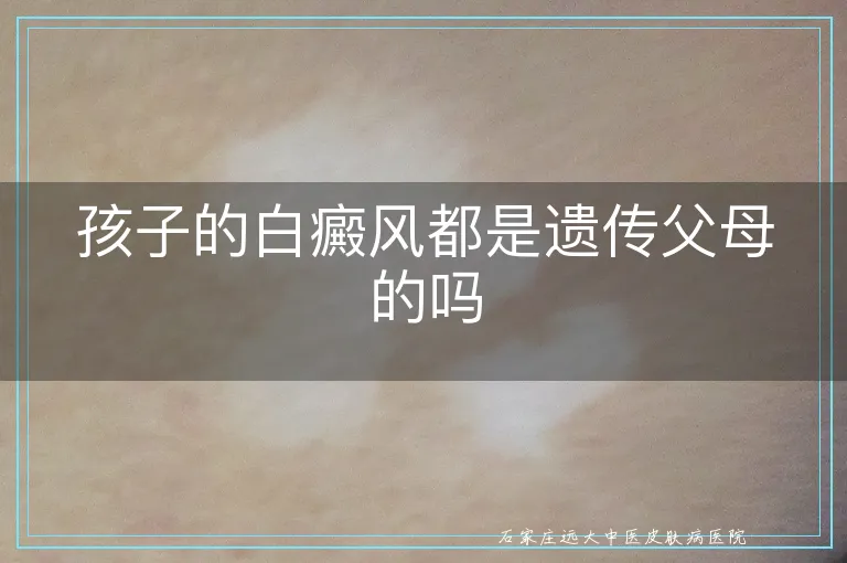 孩子的白癜风都是遗传父母的吗