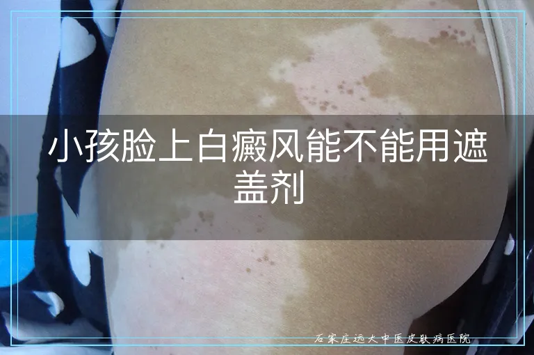 小孩脸上白癜风能不能用遮盖剂