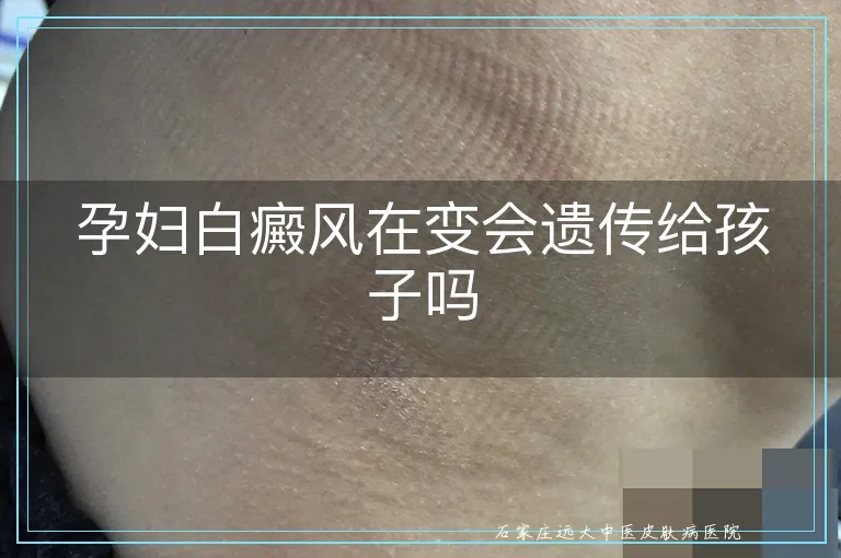 孕妇白癜风在变会遗传给孩子吗