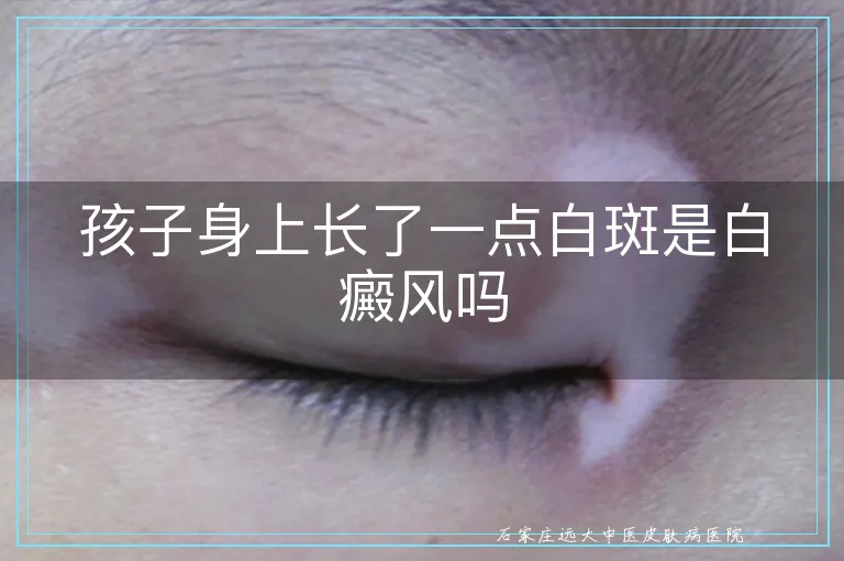 孩子身上长了一点白斑是白癜风吗