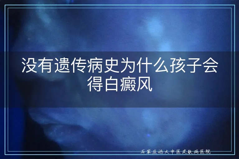 没有遗传病史为什么孩子会得白癜风