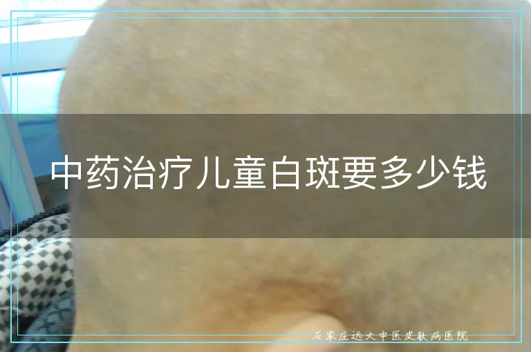 中药治疗儿童白斑要多少钱