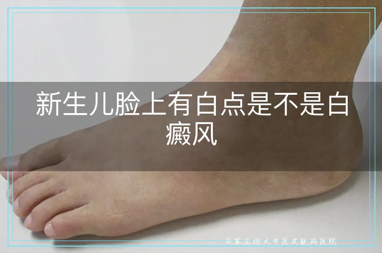 新生儿脸上有白点是不是白癜风