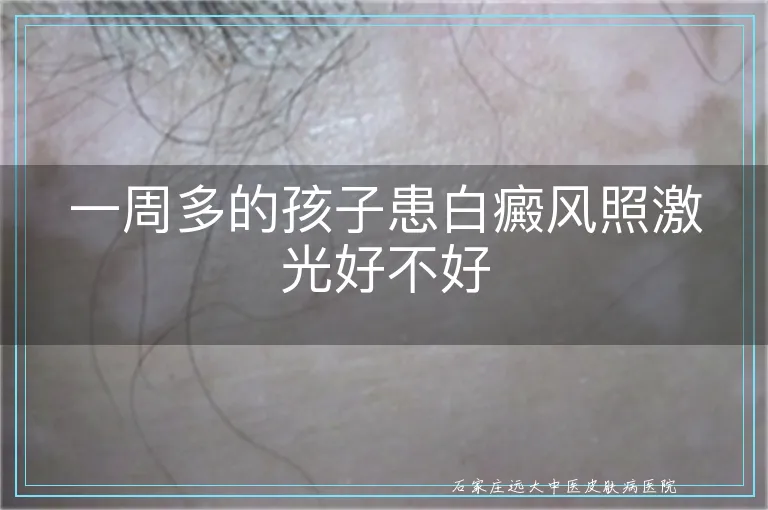 一周多的孩子患白癜风照激光好不好