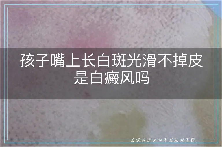 孩子嘴上长白斑光滑不掉皮是白癜风吗