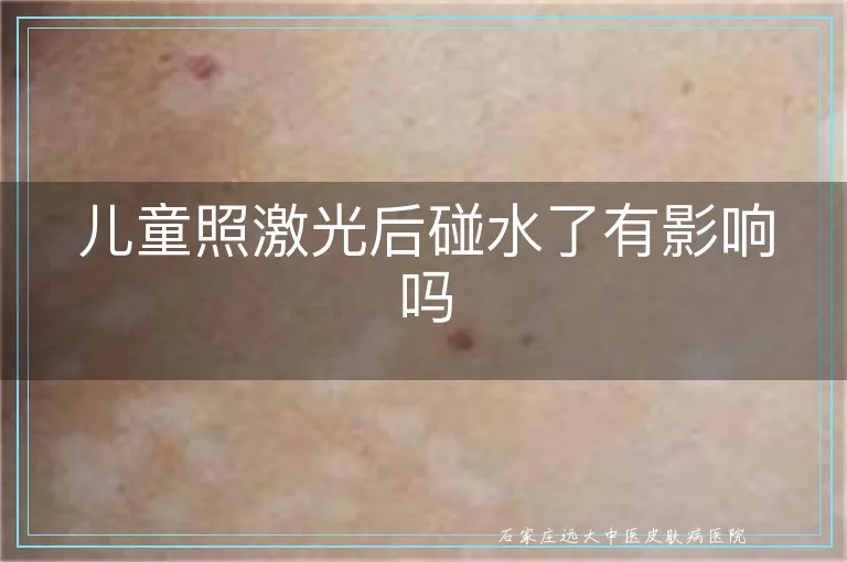 儿童照激光后碰水了有影响吗