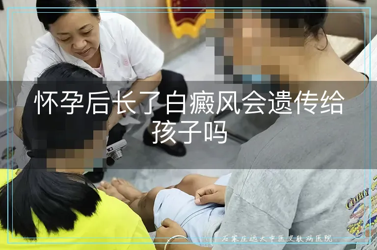 怀孕后长了白癜风会遗传给孩子吗