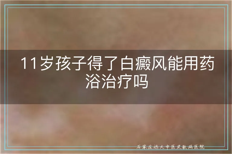 11岁孩子得了白癜风能用药浴治疗吗