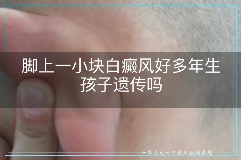 脚上一小块白癜风好多年生孩子遗传吗