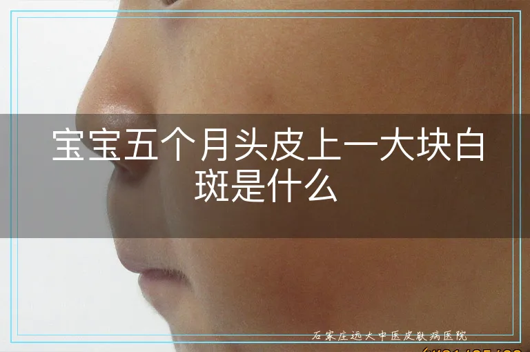 宝宝五个月头皮上一大块白斑是什么