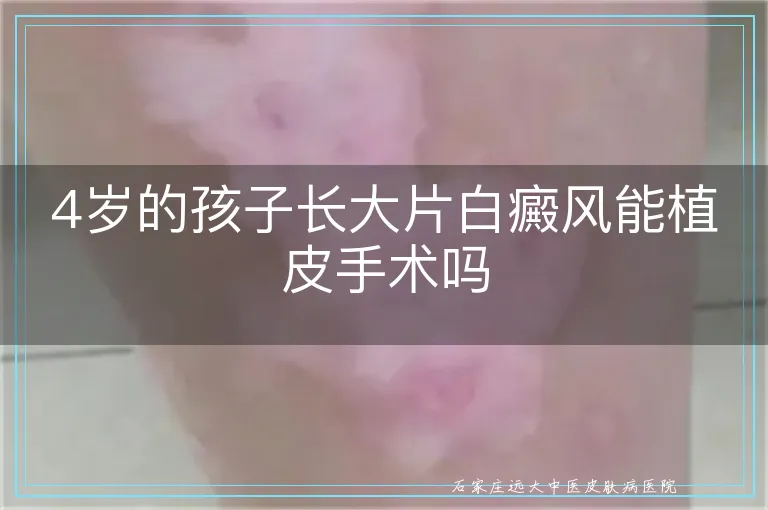 4岁的孩子长大片白癜风能植皮手术吗