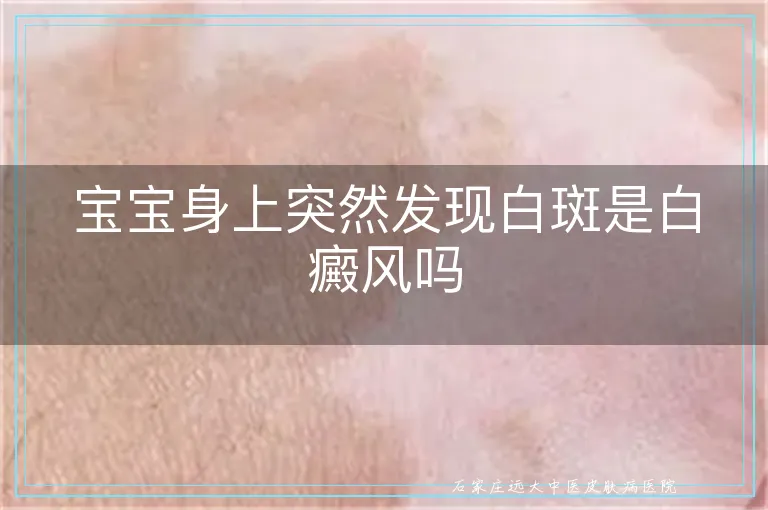 宝宝身上突然发现白斑是白癜风吗