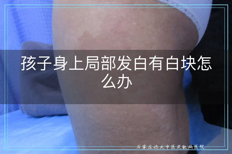孩子身上局部发白有白块怎么办