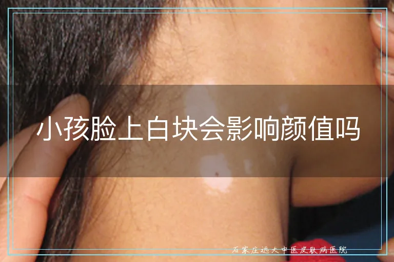小孩脸上白块会影响颜值吗