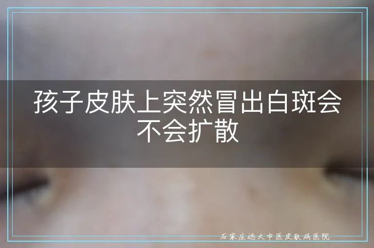 孩子皮肤上突然冒出白斑会不会扩散