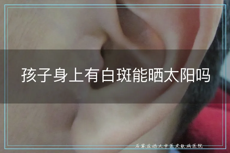 孩子身上有白斑能晒太阳吗