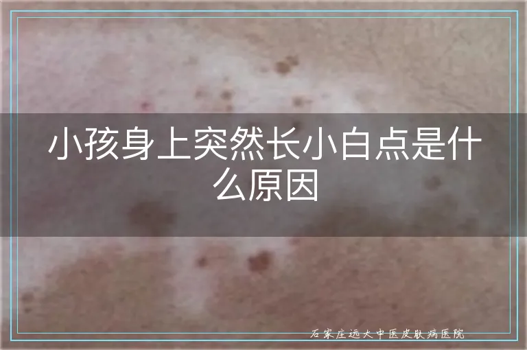 小孩身上突然长小白点是什么原因