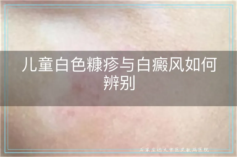 儿童白色糠疹与白癜风如何辨别