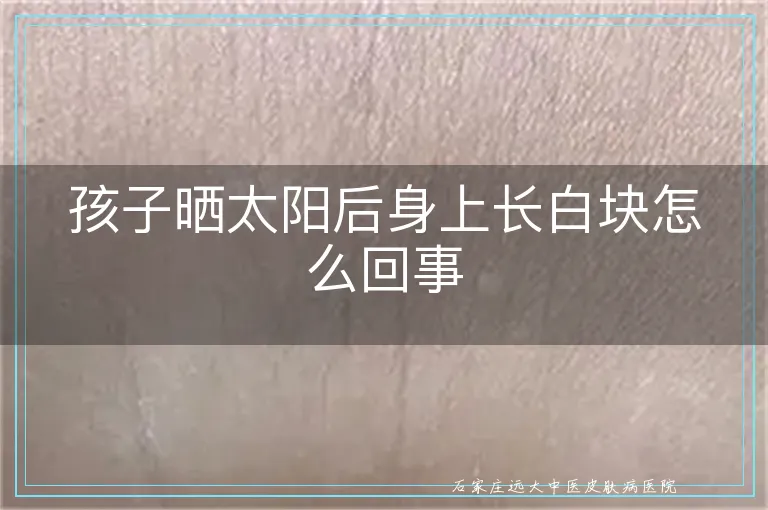 孩子晒太阳后身上长白块怎么回事