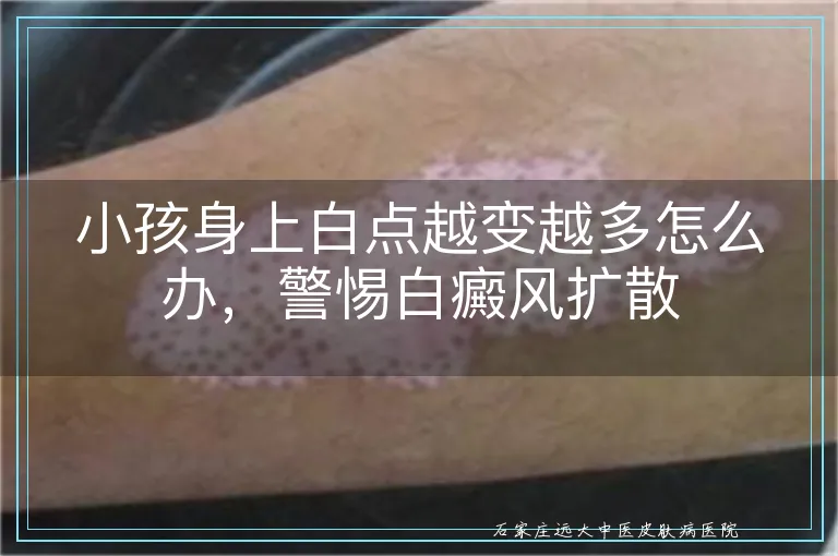 小孩身上白点越变越多怎么办，警惕白癜风扩散