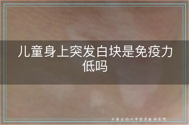儿童身上突发白块是免疫力低吗