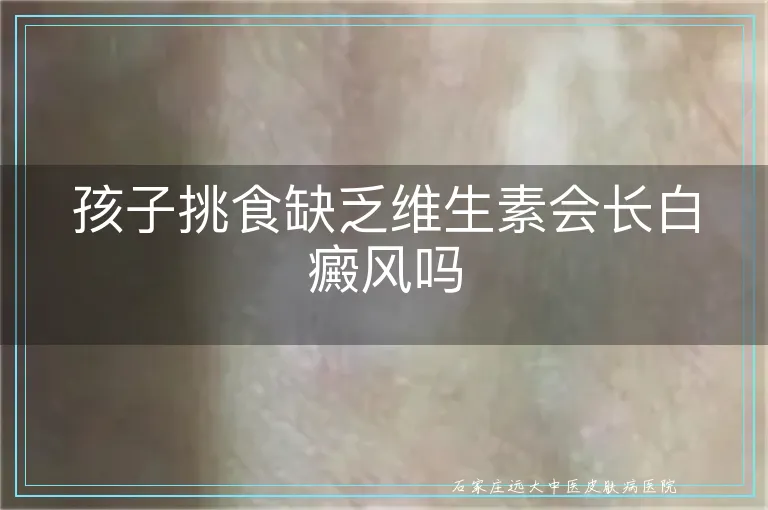 孩子挑食缺乏维生素会长白癜风吗