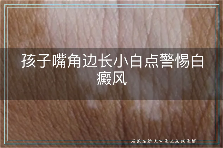 孩子嘴角边长小白点警惕白癜风