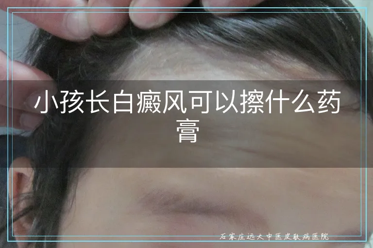 小孩长白癜风可以擦什么药膏