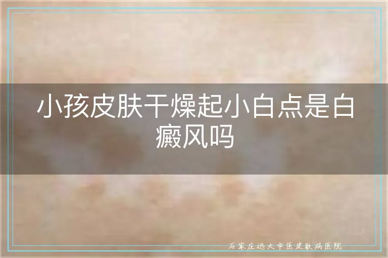 小孩皮肤干燥起小白点是白癜风吗