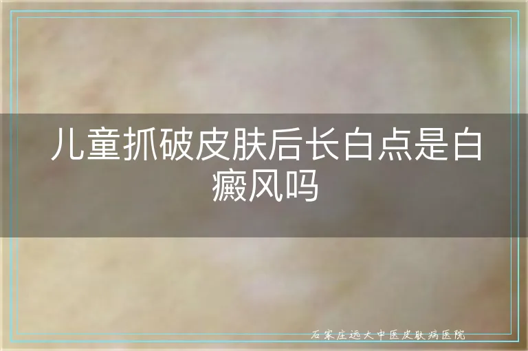 儿童抓破皮肤后长白点是白癜风吗