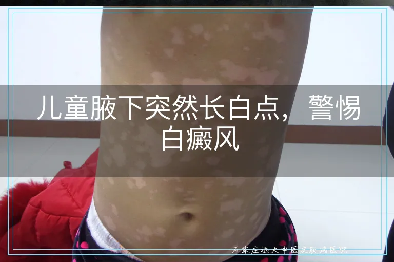 儿童腋下突然长白点，警惕白癜风