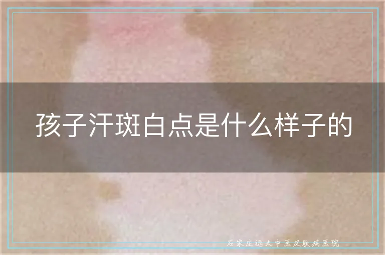 孩子汗斑白点是什么样子的