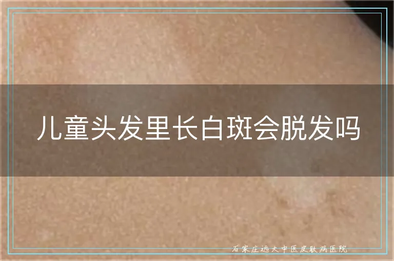 儿童头发里长白斑会脱发吗