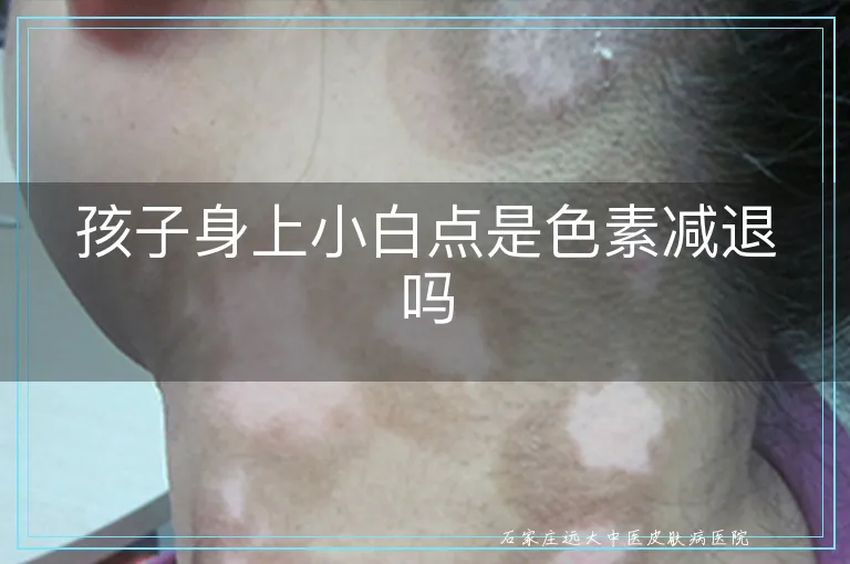 孩子身上小白点是色素减退吗