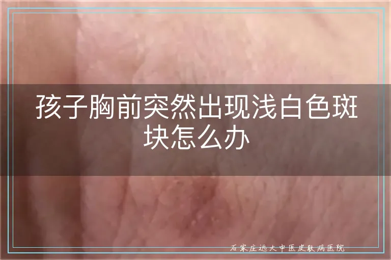 孩子胸前突然出现浅白色斑块怎么办