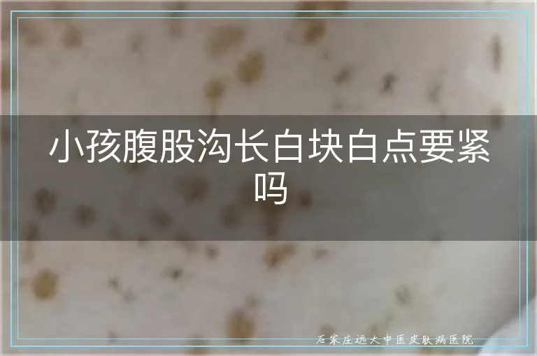 小孩腹股沟长白块白点要紧吗