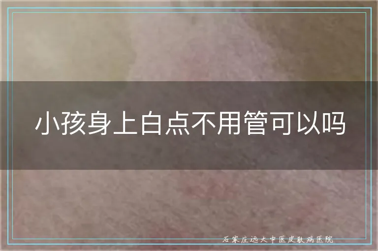 小孩身上白点不用管可以吗