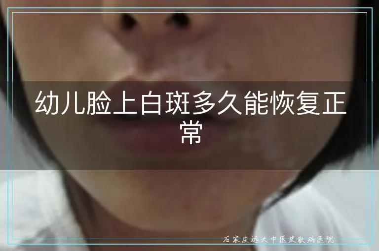 幼儿脸上白斑多久能恢复正常