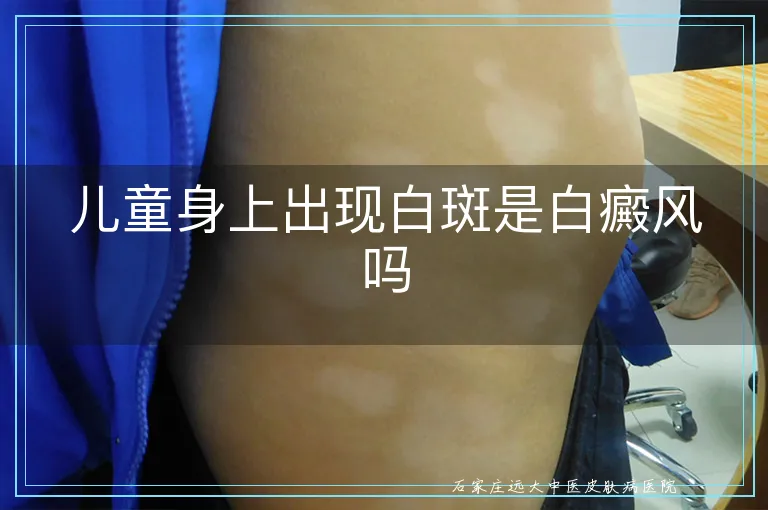 儿童身上出现白斑是白癜风吗