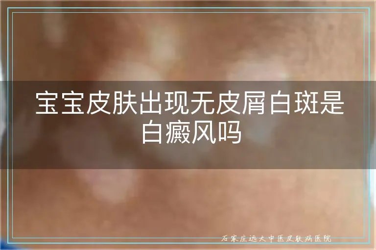 宝宝皮肤出现无皮屑白斑是白癜风吗