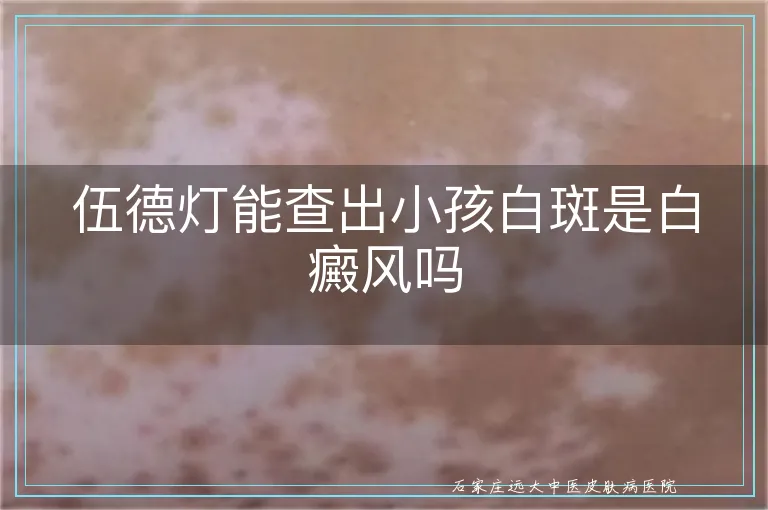 伍德灯能查出小孩白斑是白癜风吗