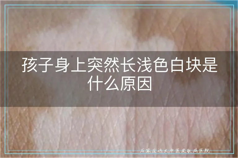 孩子身上突然长浅色白块是什么原因