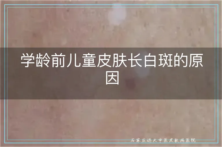 学龄前儿童皮肤长白斑的原因