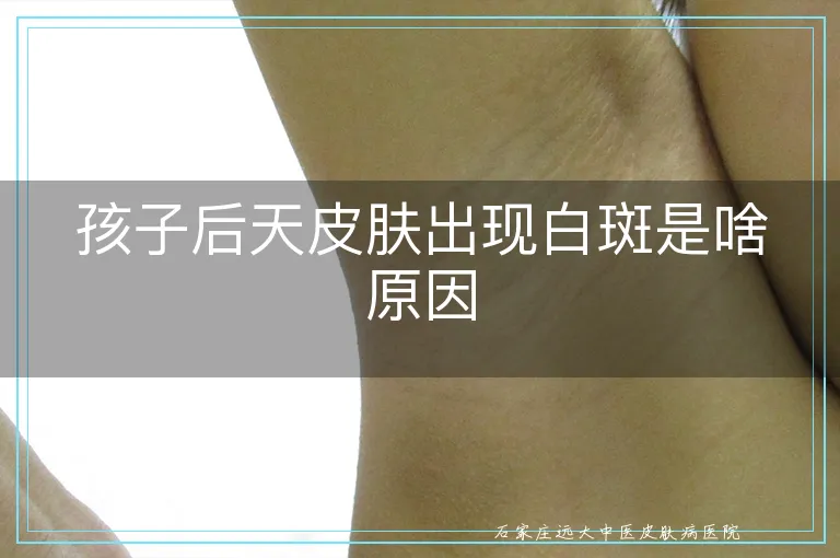孩子后天皮肤出现白斑是啥原因