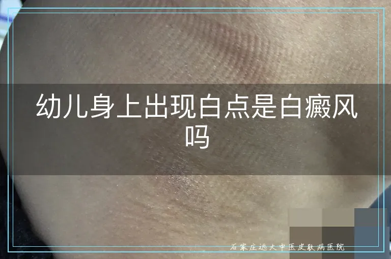 幼儿身上出现白点是白癜风吗