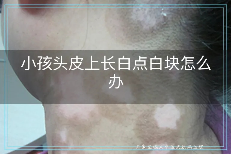 小孩头皮上长白点白块怎么办