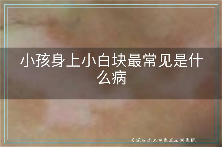 小孩身上小白块最常见是什么病