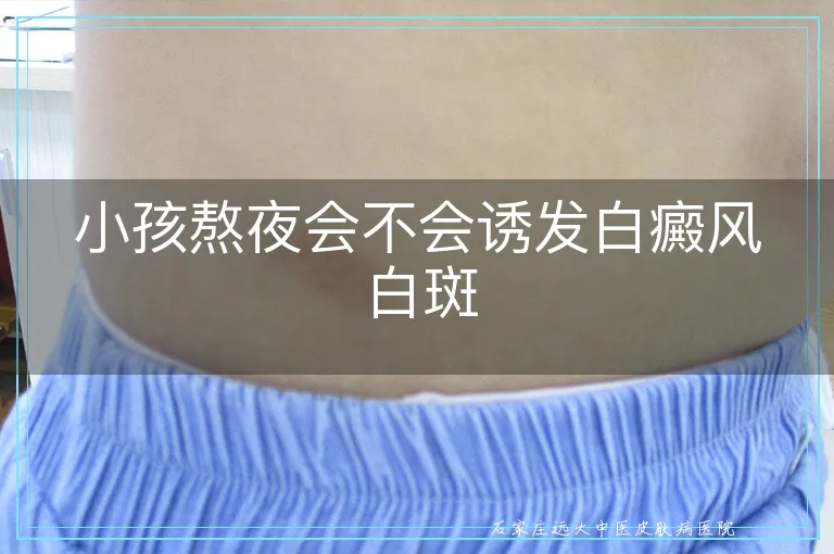 小孩熬夜会不会诱发白癜风白斑