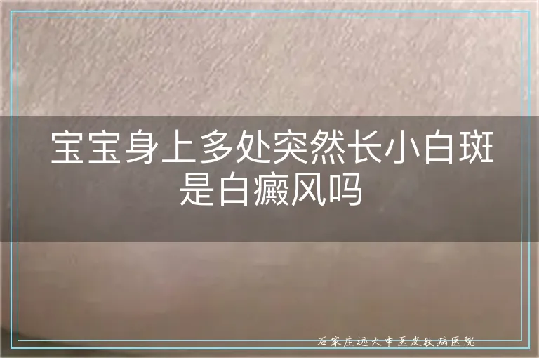 宝宝身上多处突然长小白斑是白癜风吗